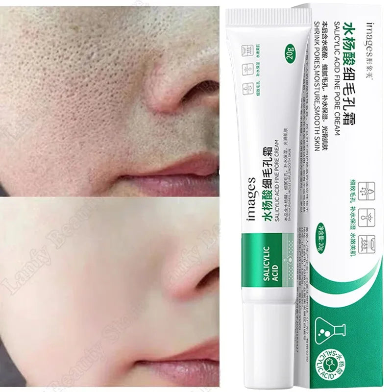 Salicylic Acid Pore Clearing Cream – Acne & Blackhead Treatment