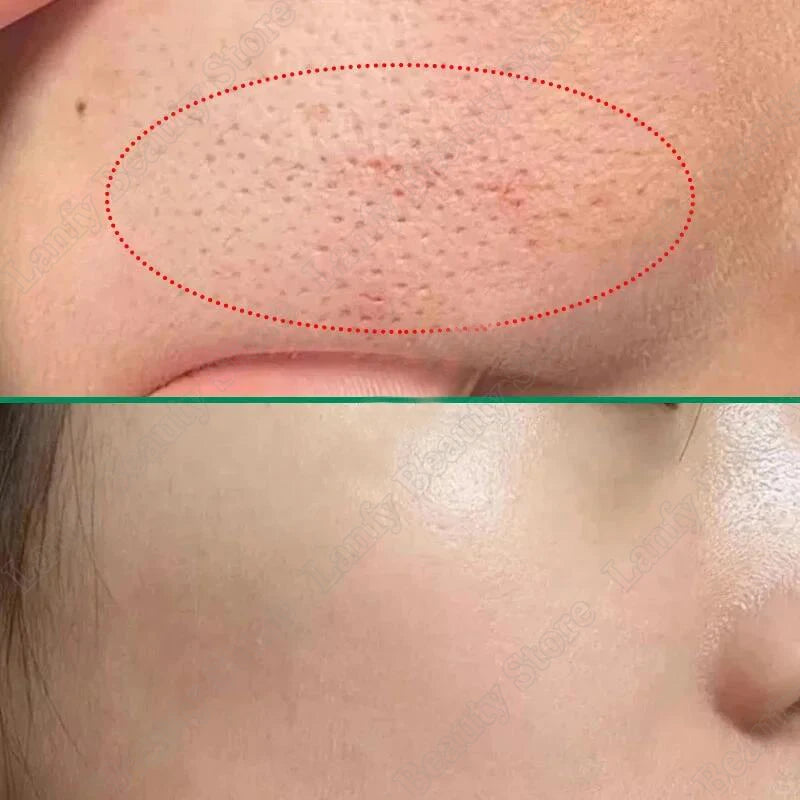 Salicylic Acid Pore Clearing Cream – Acne & Blackhead Treatment