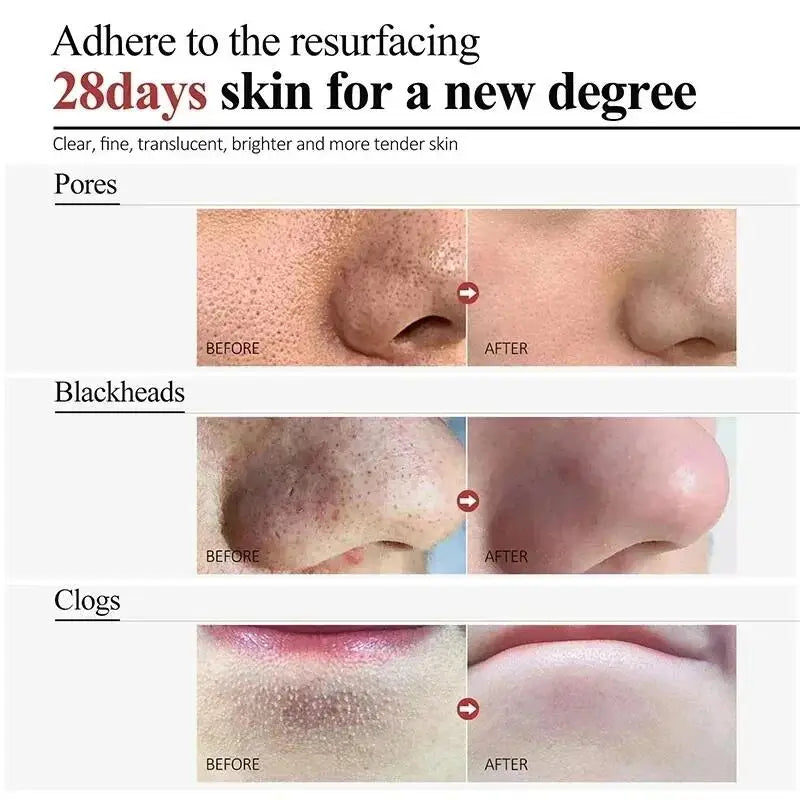 Salicylic Acid Pore Clearing Cream – Acne & Blackhead Treatment