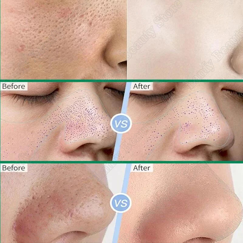 Salicylic Acid Pore Clearing Cream – Acne & Blackhead Treatment