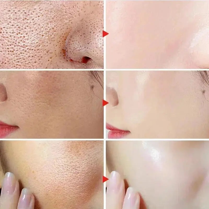 Salicylic Acid Pore Clearing Cream – Acne & Blackhead Treatment