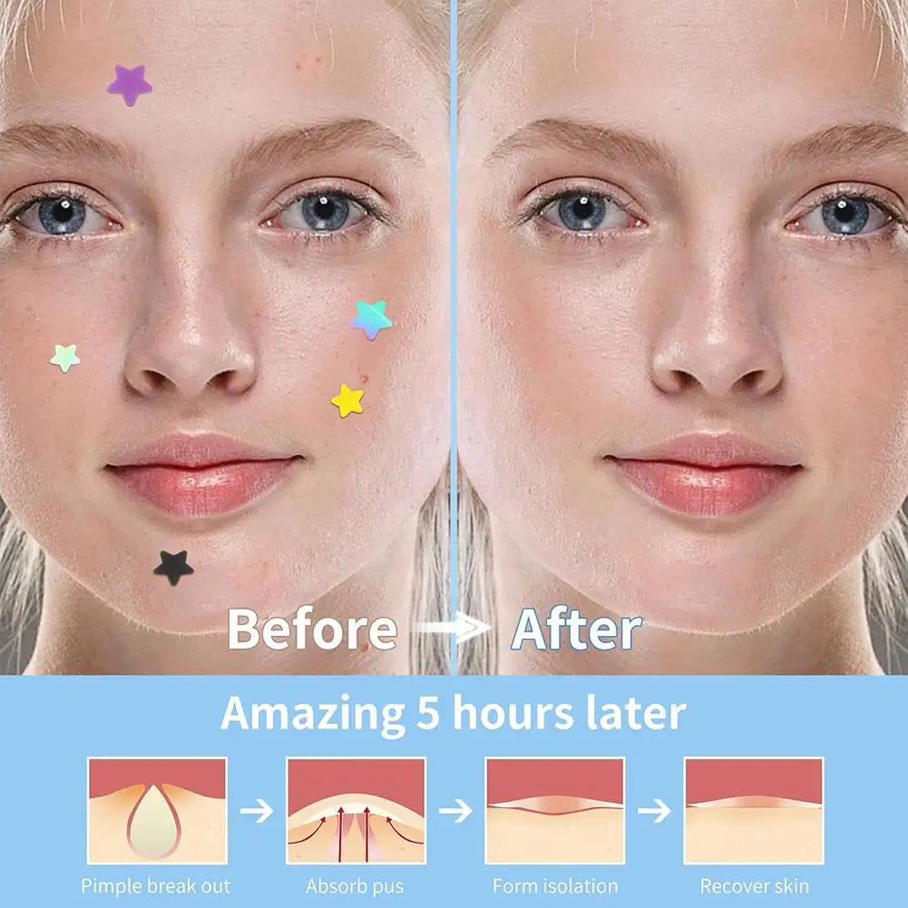 Colorful Star Pimple Patch – Invisible Acne Spot Stickers