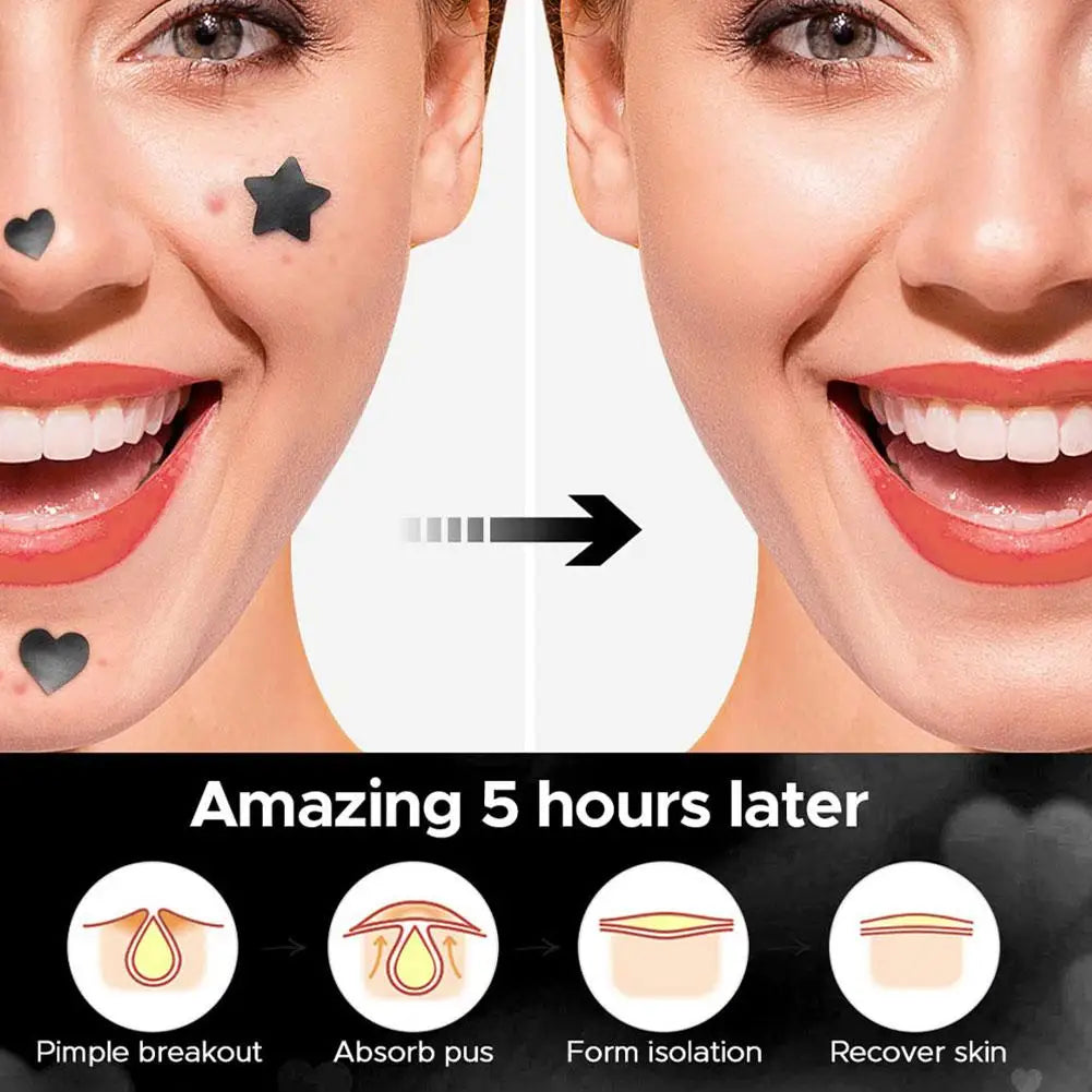 Colorful Star Pimple Patch – Invisible Acne Spot Stickers