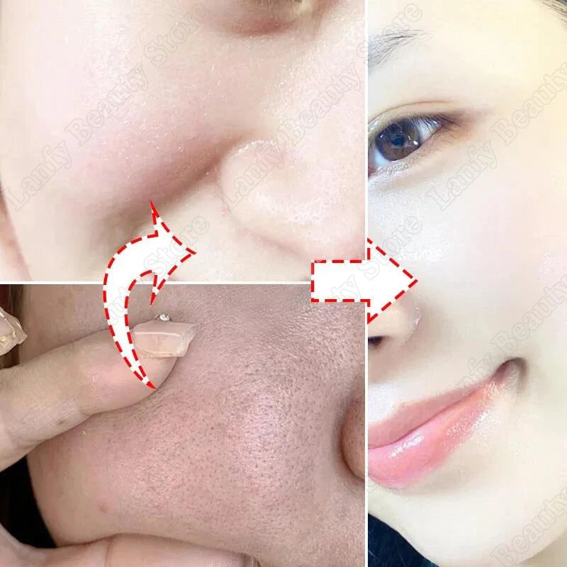 Salicylic Acid Pore Clearing Cream – Acne & Blackhead Treatment