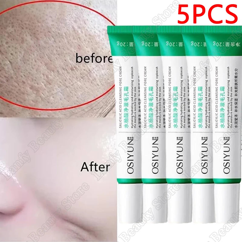Salicylic Acid Pore Clearing Cream – Acne & Blackhead Treatment