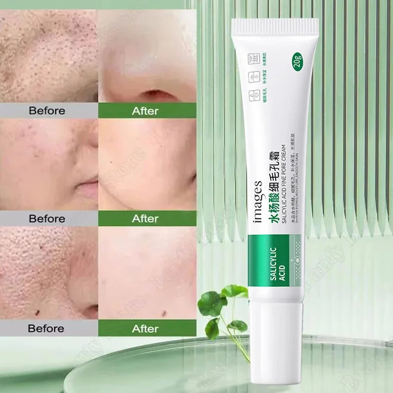 Salicylic Acid Pore Clearing Cream – Acne & Blackhead Treatment