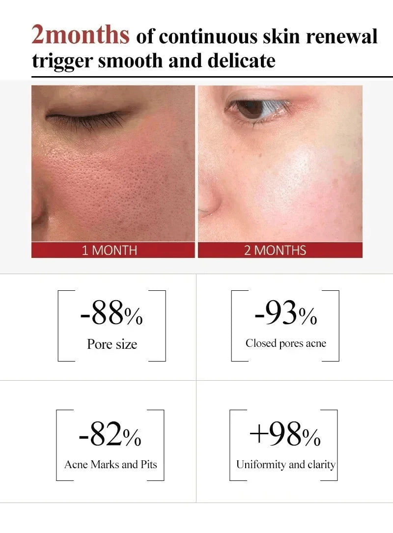Salicylic Acid Pore Clearing Cream – Acne & Blackhead Treatment