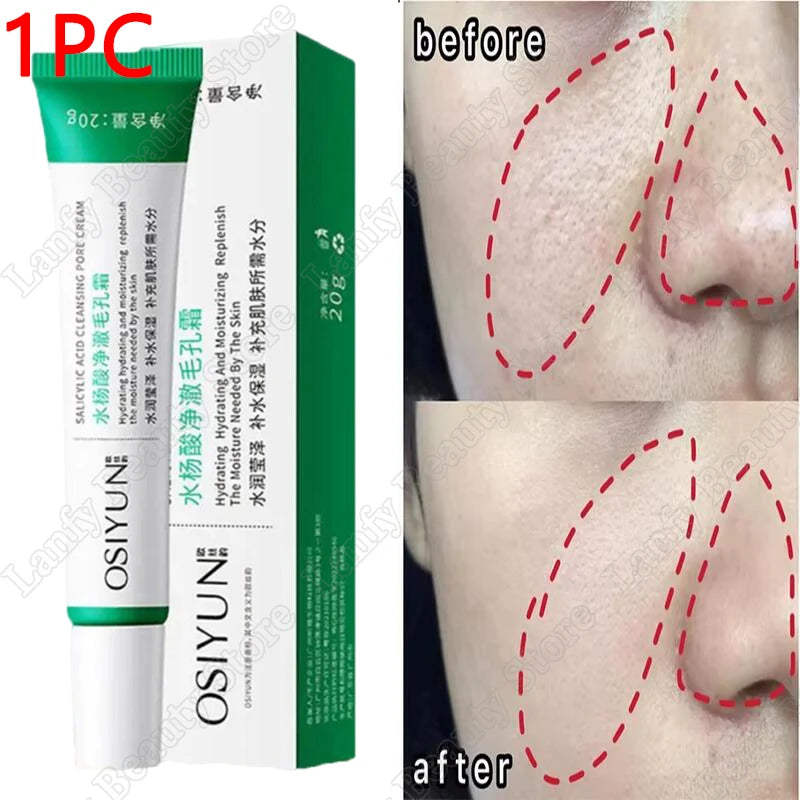 Salicylic Acid Pore Clearing Cream – Acne & Blackhead Treatment