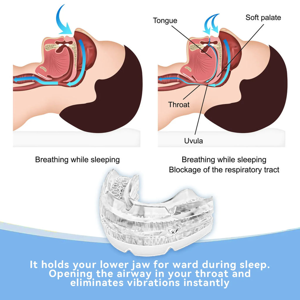 Adjustable Anti-Snoring Mouth Guard – Stop Snoring & Improve Sleep