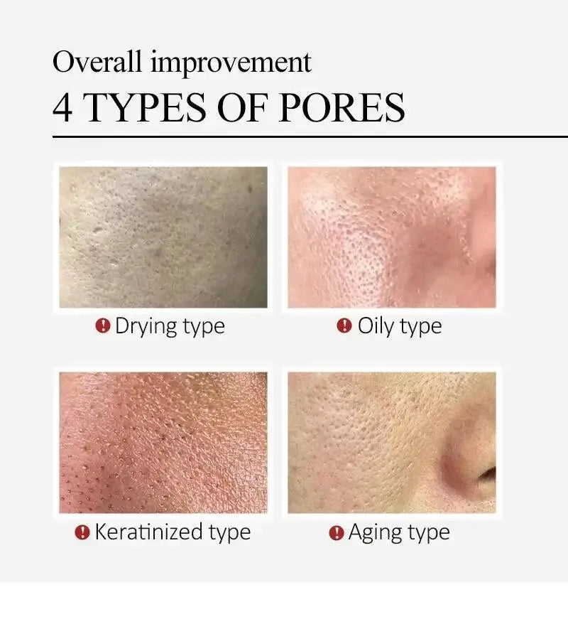 Salicylic Acid Pore Clearing Cream – Acne & Blackhead Treatment